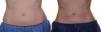 CoolSculpting Treatment Results in a Slimmer Waist