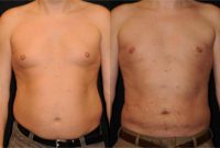 35-44 year old man treated with Liposuction