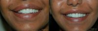 35-44 year old woman treated with Lip Reduction