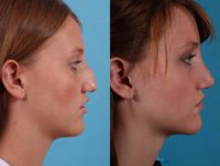 17 old woman treated with Rhinoplasty