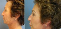 55-64 year old woman treated with Facelift and Upper Eyelid Lift