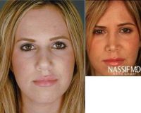 Doctor Paul S. Nassif, MD, Beverly Hills Facial Plastic Surgeon - Female Primary Rhinoplasty