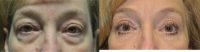 55-64 year old woman treated with Eye Bags Treatment