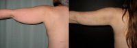 Liposuction of Arms