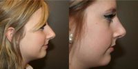 17 or under year old woman w/ Rhinoplasty and Chin Augmentation