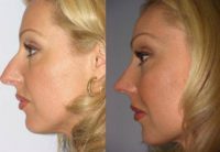 Nose Surgery (Rhinoplasty) in Boca Raton, Florida