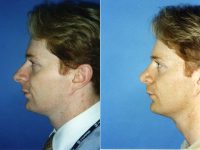 Doctor Ross A. Clevens, MD, Melbourne Facial Plastic Surgeon - Rhinoplasty