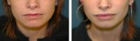 Lip Augmentation with Implant