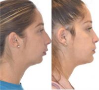 25-34 year old woman treated with Total Joint Replacement and Chin Surgery
