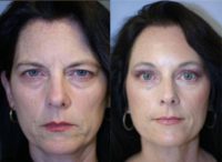 Coronal brow lift and upper lid blepharoplasty only