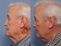 75 and up year old man treated with Mohs Surgery