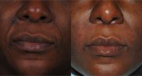 35-44 year old woman treated with Radiesse
