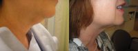 Neck Liposuction. Before and After