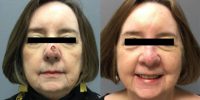 65-74 year old woman treated with Mohs Closure Surgery