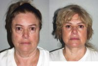 High-SMAS Face Lift, Neck Lift, Perioral Dermabrasion, Lower Eyelid Blepharoplasty, Lateral Canthopexy