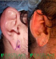 18-24 year old man treated with Earlobe Surgery