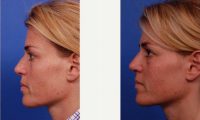 Doctor Thomas J. Walker, MD, Atlanta Facial Plastic Surgeon - Rhinoplasty On 42 Year Old Female Patient Before And 2 Months Post-op