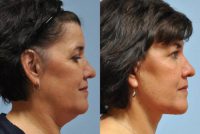58 year old woman unhappy with jowls and sagging neck
