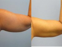 Liposuction of Arms with Thermitight