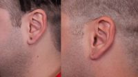 25-34 year old man treated with Ear Lobe Surgery