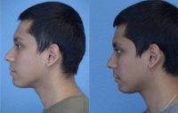 18-24 year old man treated with Non-Surgical Rhinoplasty