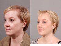 35-44 year old woman treated with Revision Rhinoplasty with rib cartilage and endoscopic browlift