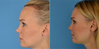 Dr Bradford A. Bader, MD, Plano Facial Plastic Surgeon - 40 Year Old Woman Treated With Rhinoplasty