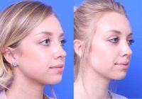 26 year old woman treated with Buccal Fat Removal for Cheek Lift
