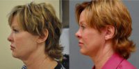 55-64 year old woman treated with Mini FaceLift