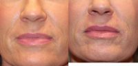 45-54 year old woman treated with Restylane Silk