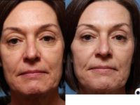 55-64 year old woman treated with Sculptra
