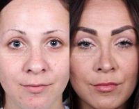 31 year old woman treated with Rhinoplasty