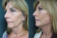 Female desires facial rejuvenation undergoes Quick Lift facelift under Local