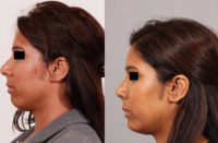 27 year old woman who underwent revision rhinoplasty with chin implant.