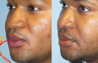 Dr Deepak K. Naidu, MD, Tampa Plastic Surgeon  - 33 Year Old Man Treated With Rhinoplasty