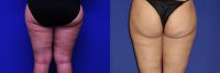 42 Year Old Female Treated with Cellulaze for Cellulite