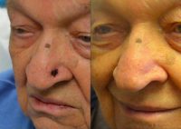 65-74 year old man treated with Mole Removal