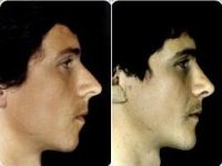 Dr Donald M. Brown, MD , San Francisco Plastic Surgeon - Male Rhiinoplasty Side Profile Before