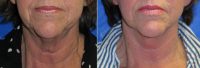 Face and Neck lift with CO2 Fractional Laser