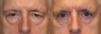 55-64 year old man treated with Eyelid Surgery