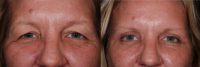 Blepharoplasty - Eye Lid Surgery and Lateral Brow Lift