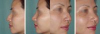 32 year-old Chinese woman who wanted the bump of her nasal bridge and her “hooked nose” look fixed