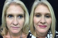 43 year old woman treated with Injectable Fillers to create a Liquid Facelift