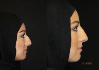25-34 year old woman treated with Non Surgical Nose Job