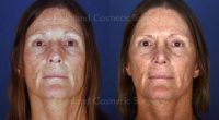 61 year old woman treated with Rhinoplasty