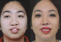 25-34 year old woman treated with Facial Reconstructive Surgery