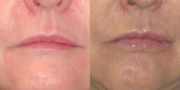 35-44 year old man treated with Lip Augmentation