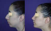 Nose and chin surgery