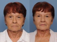 65-74 year old woman treated with Rhinoplasty