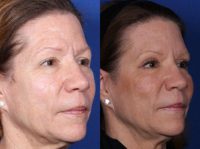 56 year old woman treated with Eyelid Surgery